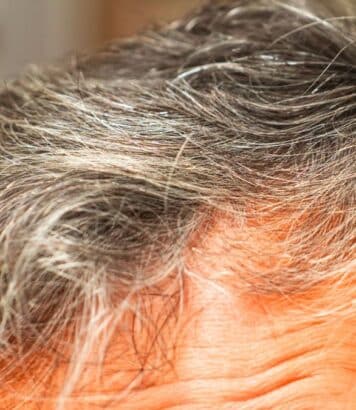Cheveux blancs : deux spécialistes révèlent ce que risque vraiment votre cuir chevelu à les arracher