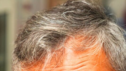 Cheveux blancs : deux spécialistes révèlent ce que risque vraiment votre cuir chevelu à les arracher