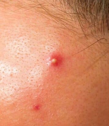 Patchs anti-boutons marguerite, panda ou cœur : les options les plus chic pour camoufler ses imperfections