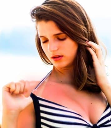 « Un vrai traumatisme » : ce que révèle votre peau qui pèle après un coup de soleil