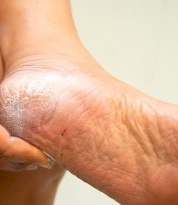 Les podologues sont formels sur la râpe à talons qui aggrave la corne au lieu de l'effacer