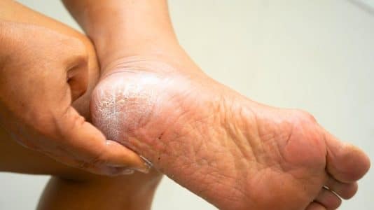 Les podologues sont formels sur la râpe à talons qui aggrave la corne au lieu de l'effacer