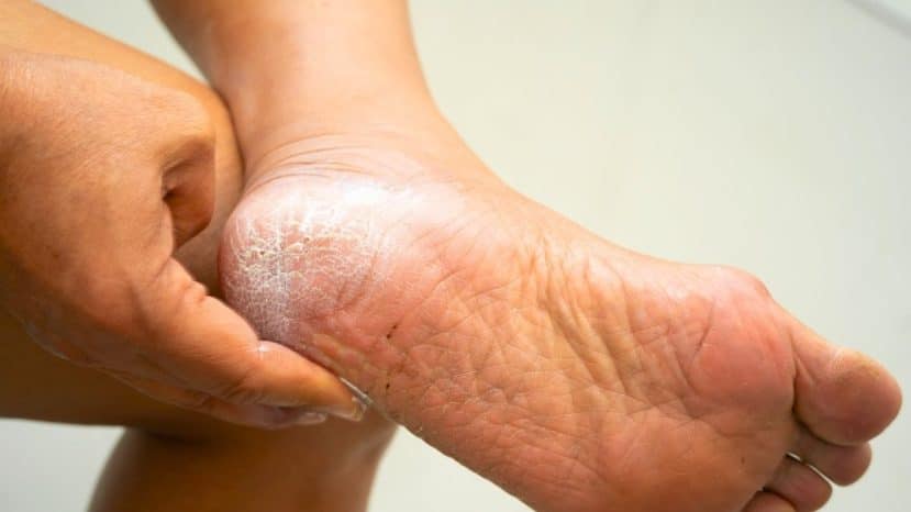 Podiatrists are clear: heel rasps make calluses worse, not better